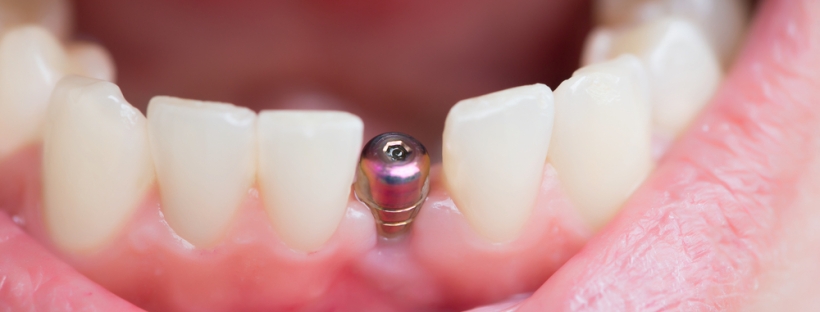 Dental Implant: Its Advantages, Disadvantages, and Risks
