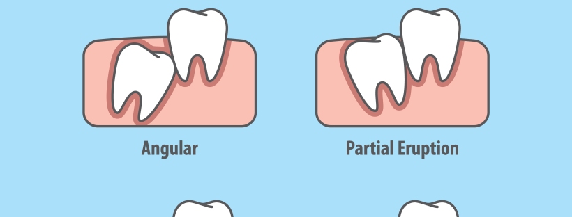 Tooth Impaction Causes Symptoms Prevention And Cure